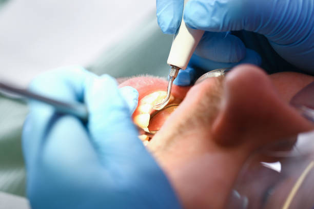 Best Emergency Root Canal Treatment in Enon, OH